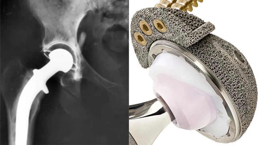 3d printed hip replacement 